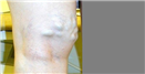 Varicose Veins